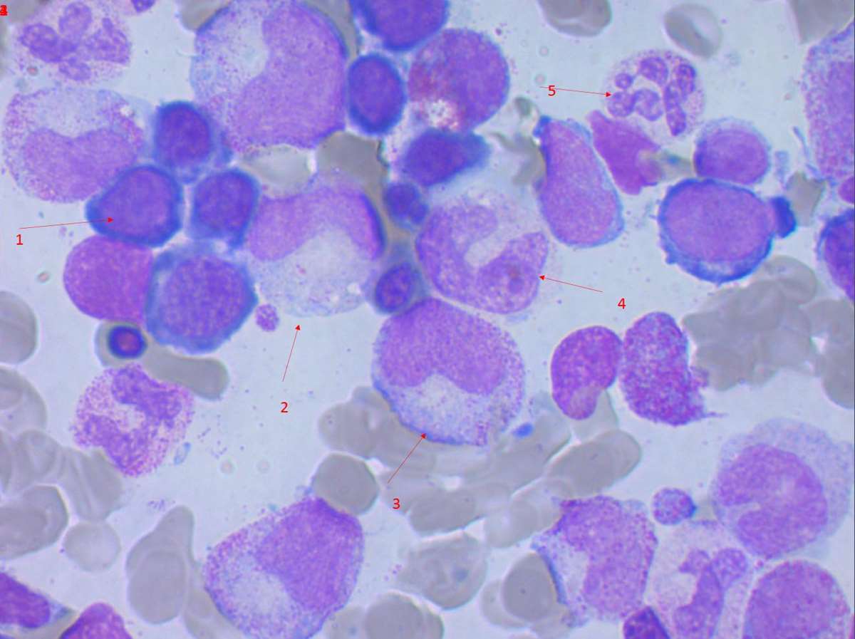Benmargsutstryk fra pasient med klassisk B12-mangel. 1 er en erytroblast, 2 og 3 store metamyelocytter, 4 er en kjempestav og 5 er en hypersegmentert nøytrofil granulocytt. Foto: Inger Berit Hersleth.
